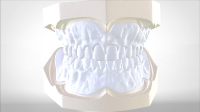 digital try in dentadura postiza inyección moldura dental 3d diente canalla 3shape labmagic3dcad médico odontología moldeo ciencias boca disparo llave 3d print model - Mito3D