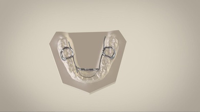 digital williams appliance science 3d cadcam orthodontic appliances splints 3shape renderer other 3d print model - Mito3D