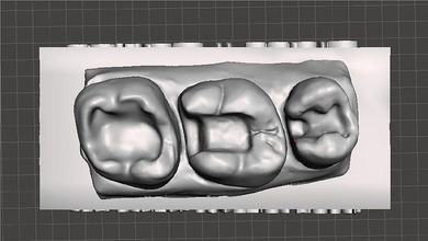 erozyon diş uygulama standart üst model sınıf 1 2 doktoru emaye hekimliği önceki bileşik azı dişi dişlenme ağız kuspid köpek keskin bilim 3d print model - Mito3D
