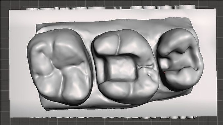erozyon diş uygulama standart üst model sınıf 2 m1 p2 doktoru emaye hekimliği önceki bileşik azı dişi dişlenme ağız kuspid köpek keskin bilim 3d print model - Mito3D