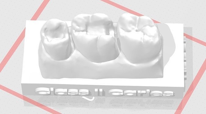 edm dental práctica estándar superior modelo clase 2 muestra dientes esmalte diente dentista cepillo anatomía molar dentina boca dentición ciencias 3D print model - Mito3D