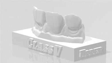 edm dental practice standard upper model class 5 dentist enamel teeth tooth dentistry anterior composite molar dentition mouth cuspid canine incisive science 3d print model - Mito3D