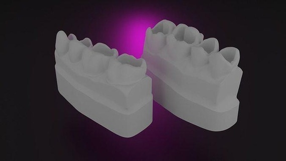 guidline composite filling anatomy dental cavity class 2 arch upper teeth tooth quadrant science biology dentist dentistry incisor orthodontist 3d print model - Mito3D