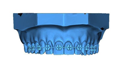 umano denti parentesi graffe mascella impressione 3d scansione anatomico medico scienza biologia 3d print model - Mito3D