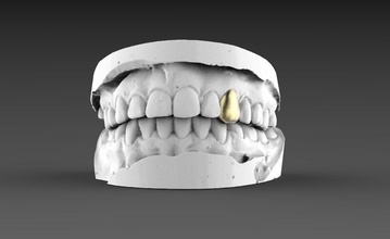 jaw teeth skeleton skull stomatology dentist caries seal gold art grillz jewelry 3d print model - Mito3D