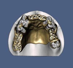 metal framework rpd design teeth denture anatomy tooth mouth dental dentist jaw dentistry gum incisor metalframe science biology 3d print model - Mito3D