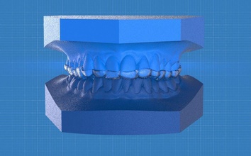 ortho anterior reposicionamiento de la férula ciencia dental cad ortodoncia 3d stl obj médica 3shape otros 3d print model - Mito3D
