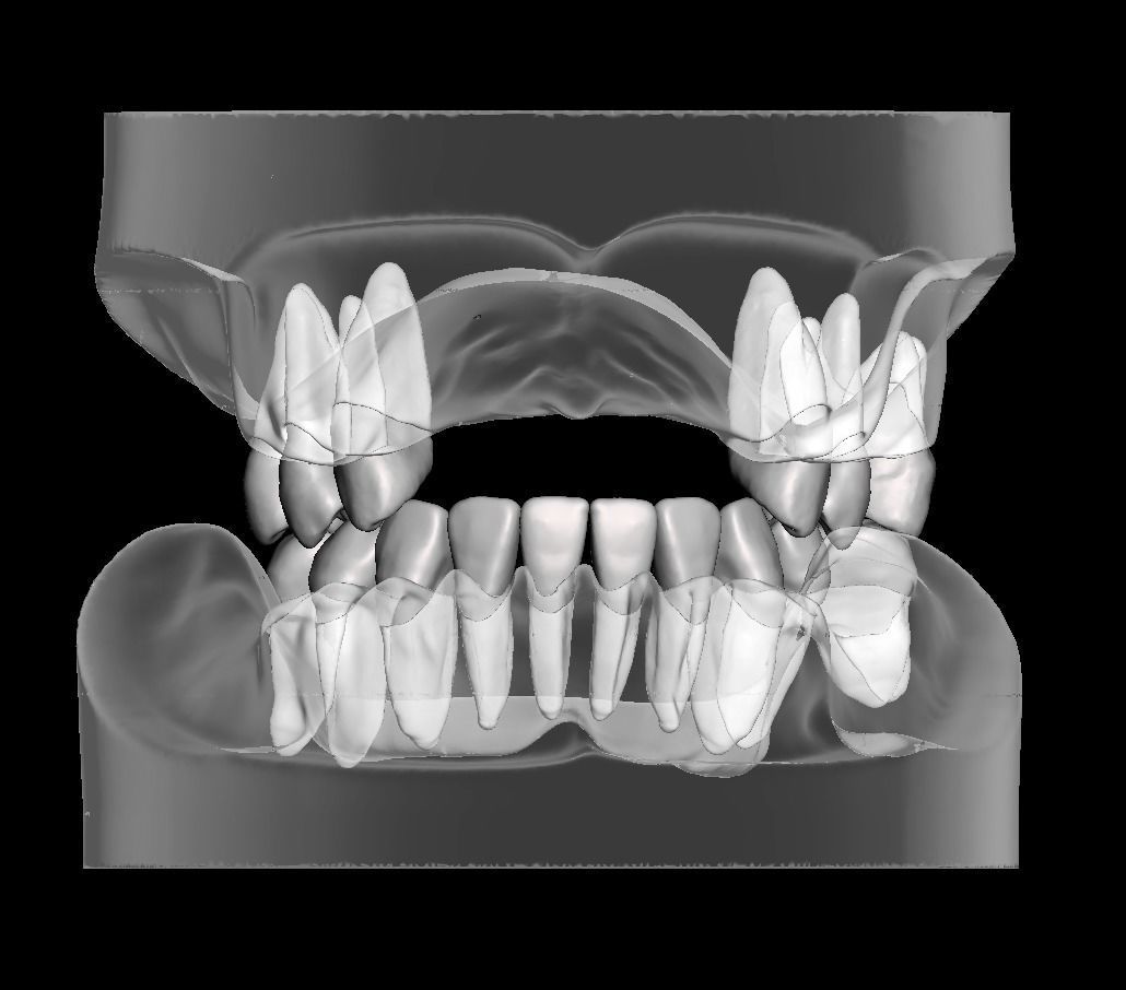 teilweise zahnlos modell individuell zähne anatomie emaille zahn mund dental kiefer zahnarzt zahnheilkunde gummi pflege unterkiefer oberkiefer prothese rpd wissenschaft biologie 3D print model - Mito3D