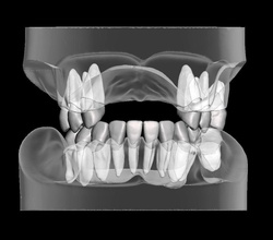 partial edentulous model individual teeth teeth anatomy enamel tooth mouth dental jaw dentist dentistry gum dental care mandibular maxillary denture rpd science biology