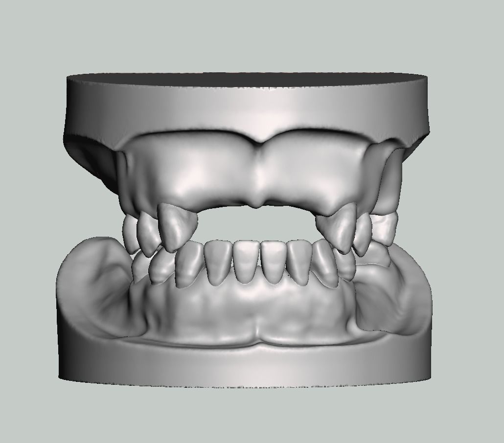 parcial desdentado modelo sólido tipo superior dientes dentadura anatomía diente boca dental dentista goma ortodoncista dentina ciencias biología 3D print model - Mito3D