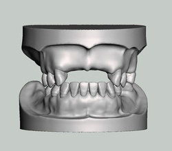 parziale edentulo modello solido genere superiore denti protesi anatomia dente bocca dentale dentista gomma ortodontista dentina scienza biologia 3d print model - Mito3D
