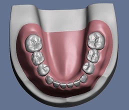pädiatrisch dental modell gummi befestigung schraube löcher anatomie zähne zahnheilkunde zahn typodont kind molar bisherige milchzahn wissenschaft biologie 3d print model - Mito3D