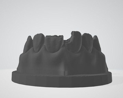 segmenté précédent classe iv vi edm dentaire entraine laboratoire dentisterie cabinet art dentiste esthétiquedentiste école science 3d print model - Mito3D
