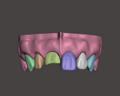 segmenté précédent couronne préparation direct vernis edm cabinet dentaire dentiste science dentisterie dents bouche dent laboratoire art photographie école 3d print model - Mito3D