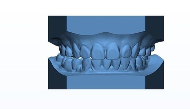 teen dental study model teeth orthodontic intraoral scanner 3d printing science biology 3d print model - Mito3D