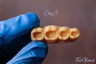 diş üst kemer sınıf 1 modeller hekimliği bileşik boşluk bilim doktoru azı dişi ortodontist çökmek kesici biyoloji 3d print model - Mito3D