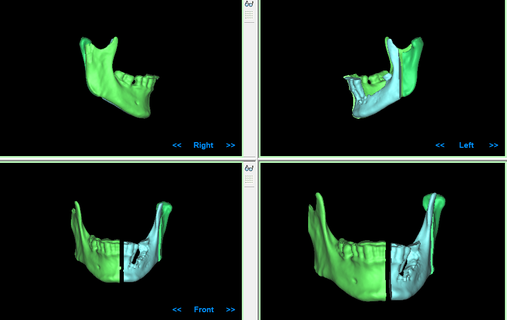 recontruccion mandibular paraca panificacion quirurgica biología médico 3d print model - Mito3D