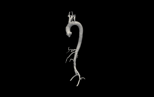 3d Modell Aorta Schiff Baum generiert Real geduldig verschiedene Bogen kardioaskulär System Vene Venen Arterie Arterien 3d print model - Mito3D