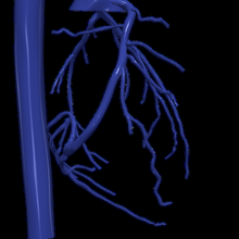 3d model aort koroner arterler 3d print model - Mito3D