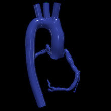 3d model aort koroner arterler 3d print model - Mito3D