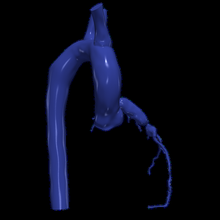 3d modelo aorta coronario arterias 3d print model - Mito3D