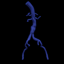 3d modelo aorta femoral artérias 3d print model - Mito3D
