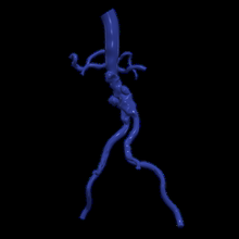 3d model aorta femoral arteries 3d print model - Mito3D