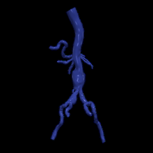 3d modèle aorte fémoral artères 3d print model - Mito3D