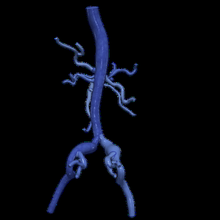 3d model aort femoral arterler 3d print model - Mito3D