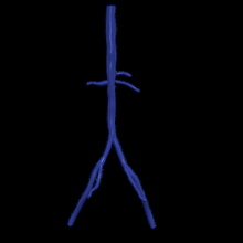 3d modelo aorta femoral arterias 3d print model - Mito3D
