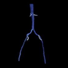 3d model aort femoral arterler 3d print model - Mito3D