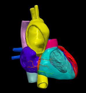 3d Modell Bicuspidus Aorta Ventil Vater Herz kardiovaskulär System Kammern apikal Aussicht Kardiologie angeboren Defekt 3d print model - Mito3D