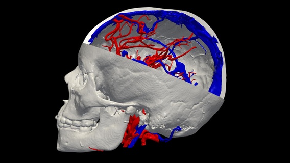 3d Modell Gehirn arteriovenös Missbildung avm zerebral vaskulär neurologisch Störung bluten Blutung Blut Schiffe Symptome Behandlung 3d print model - Mito3D