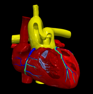 3d model common arterial trunk truncus arteriosus heart cardiovascular cardiac system chambers apical view cardiology congenital disease 3d print model - Mito3D