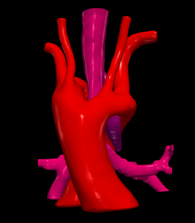 3d model double aortic arch trachea Various cardiovascular cardiac heart health aorta 3d print model - Mito3D