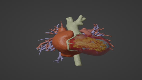 3d modelo saudável humano coração gerado real paciente cardiovascular cardíaco câmaras apical Visão cardiologia 3d print model - Mito3D