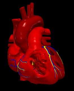 3d model heart atrial septal defect medicine anatomy cardiovascular system aorta left ventricle right atrium pulmonary artery 3d print model - Mito3D