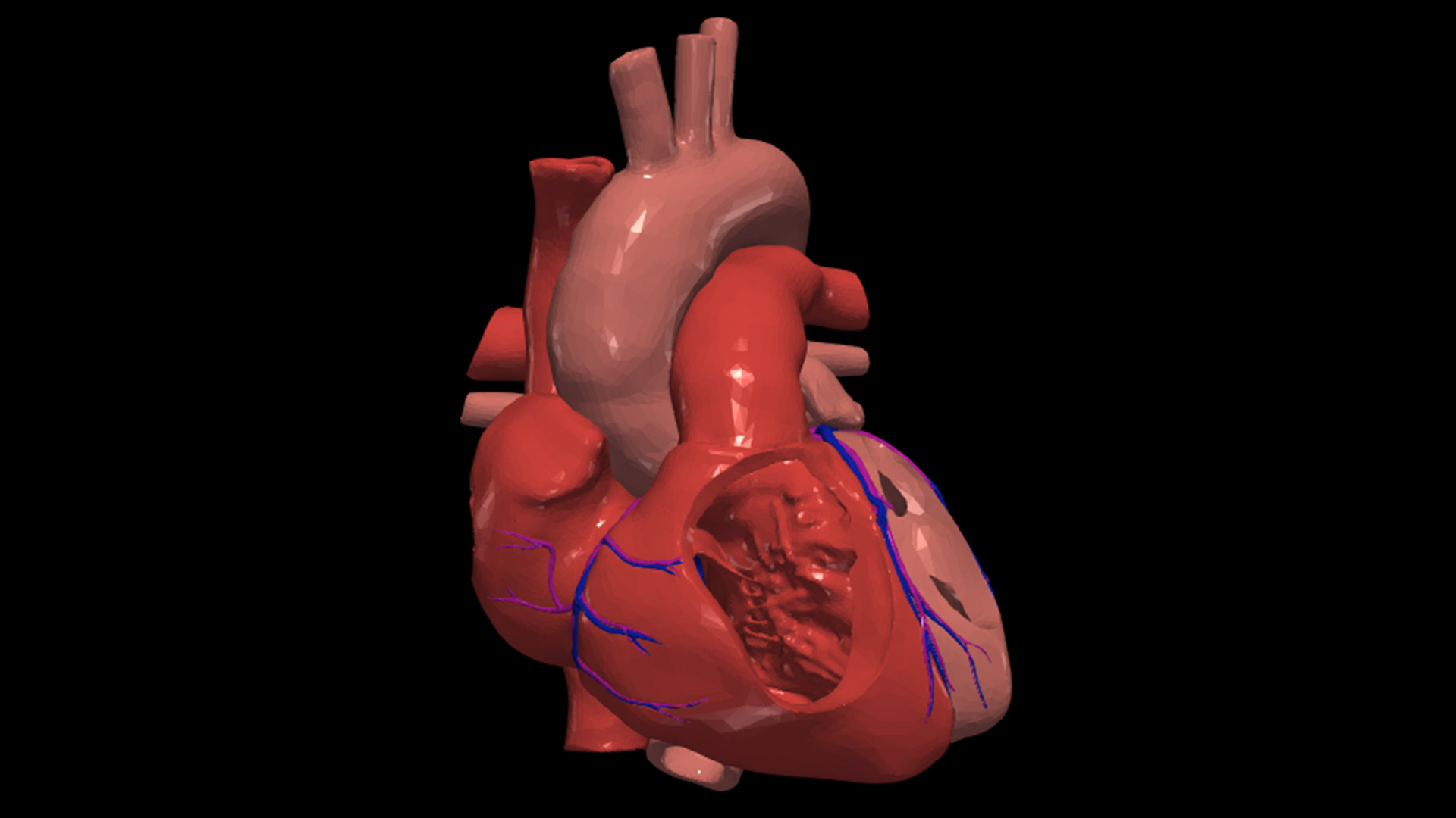 3d model heart atrial septal defect cardiovascular cardiac system chambers apical view cardiology 3D print model - Mito3D