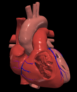 3d modello cuore atriale settale difetto cardiovascolare cardiaco congenita patologia difetti Salute 3d print model - Mito3D