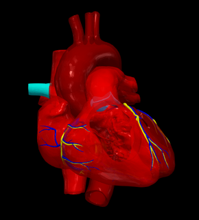 3d modello cuore parziale anomalo polmonare venoso connessione cardiovascolare cardiaco congenita patologia difetti Salute 3d print model - Mito3D