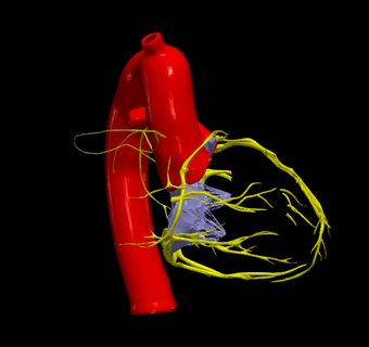 3d model heart tetralogy fallot medicine anatomy cardiovascular system aorta left ventricle right atrium pulmonary artery 3d print model - Mito3D
