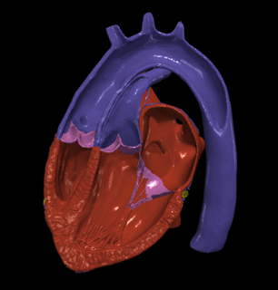 3d Modell Herz Umsetzung großartig Arterien Achse Aussicht verschiedene kardiovaskulär System Kammern apikal Kardiologie angeboren Krankheit 3d print model - Mito3D