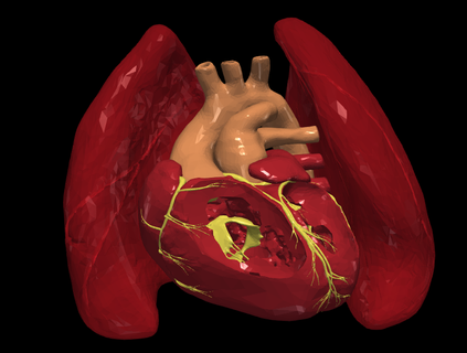 3d model kalp transpozisyon harika arterler kardiyovasküler doğuştan hastalık kusurlar sağlık 3d print model - Mito3D