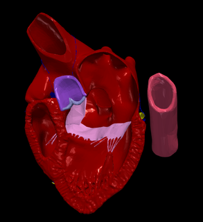 3d model heart wirh atrioventricular septal defect 4 chamber view medicine anatomy cardiovascular system aorta left ventricle right atrium pulmonary artery 3d print model - Mito3D