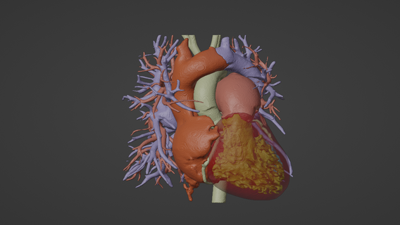 3d model human heart anomalous pulmonary venous drainage apvc - generated real patient cardiovascular cardiac system chambers apical view cardiology 3d print model - Mito3D