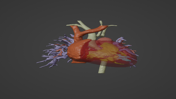 3d model human heart aortic arch hypoplasia aah - generated real patient cardiovascular cardiac system chambers apical view cardiology aorta congenital disease 3d print model - Mito3D