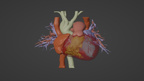 3d model human heart atrial septal defect asd - generated real patient cardiovascular cardiac system chambers apical view cardiology 3d print model - Mito3D