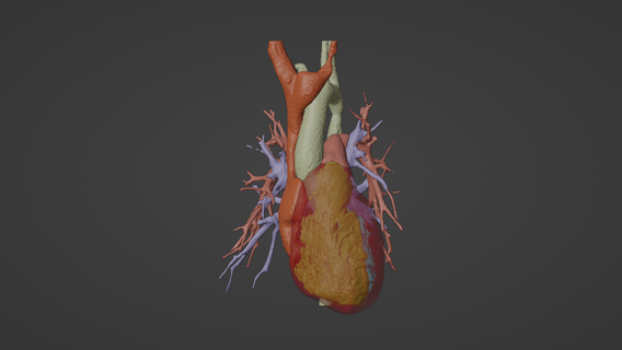 3d model human heart atrio-ventricular septal defect avsd - generated real patient cardiovascular cardiac system chambers apical view cardiology 3d print model - Mito3D