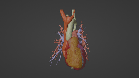 3d modelo humano coração co arctation gerado real paciente cardiovascular cardíaco câmaras apical Visão cardiologia 3d print model - Mito3D