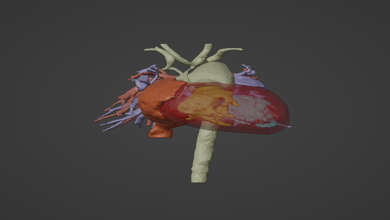 3d modelo humano coração comum arterial tronco gato gerado real paciente cardiovascular cardíaco câmaras apical Visão cardiologia 3d print model - Mito3D